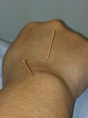 Wrist pain from scar tissue being treated with acupuncture.