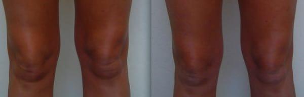 Actual Patient:  Mesotherapy for Knee Fat