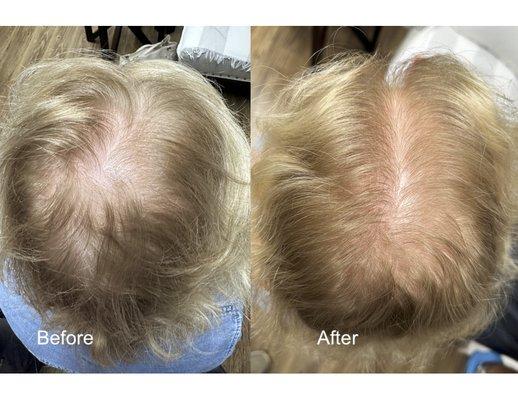 Our women's hair regrowth team has over 15 years of regenerative experience in PBC hair restoration...