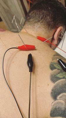 Electro-acupuncture for shoulder pain