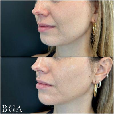 Before & After - Chin Filler - Lower Face Enhancement