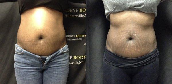 Laser fat removal