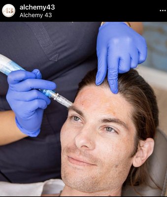 Microneedling is for men, too!