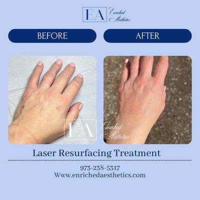 Laser Resurfacing treatment. Before and after