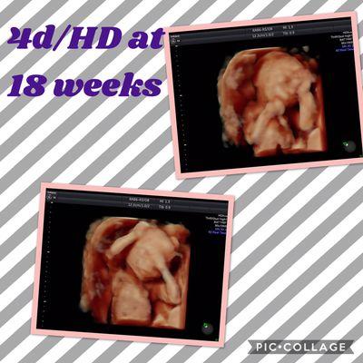 4d Ultrasound at 18 weeks