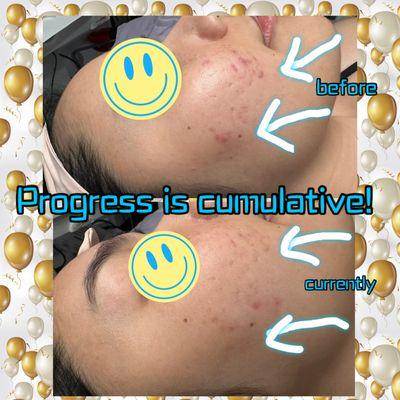 Hyperpigmentation takes time but results are outstanding!