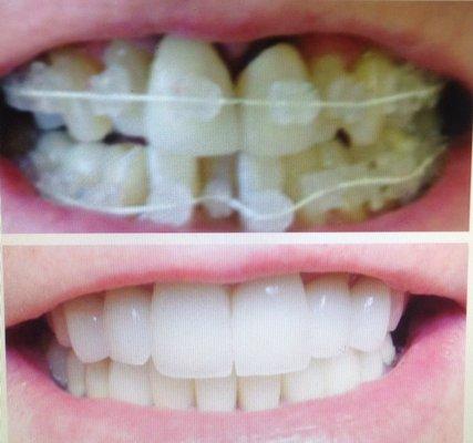 Before & after  Crowns done & corrected teeth with ortho