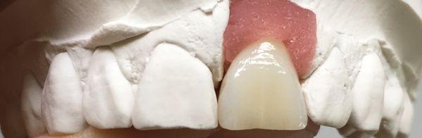 Custom designed porcelain layered to zirconium metal free anterior crown.