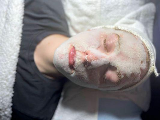 Acne Facial