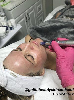 Microneedling treatment- Collagen induction therapy