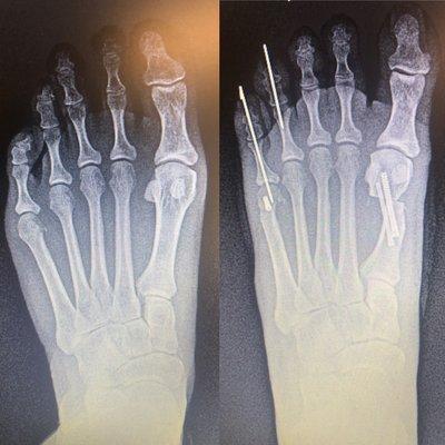 Minimally invasive bunion