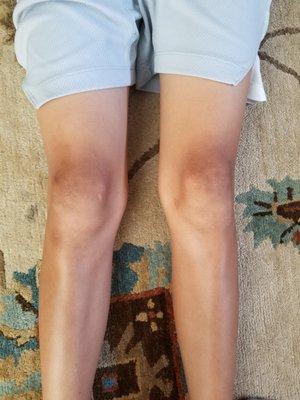 a 14 yr old's damaged knees from trendy training techniques...he was doing lots of walking lunges