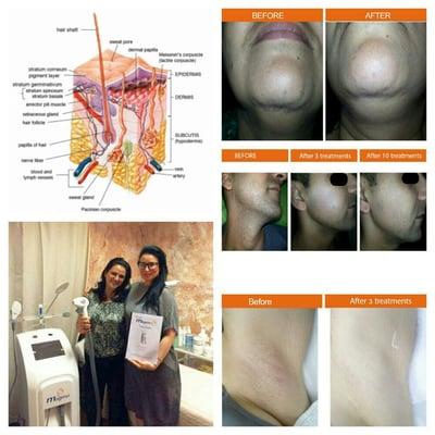 We are so excited to present the Magma IPL skin rejuvenation and laser hair removal system.