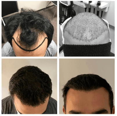 Hair Transplant
Real Clients Real Results!