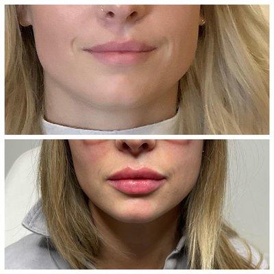 Lip Filler. Juvederm