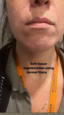 Dermal fillers to nasolabial folds and marionette lines