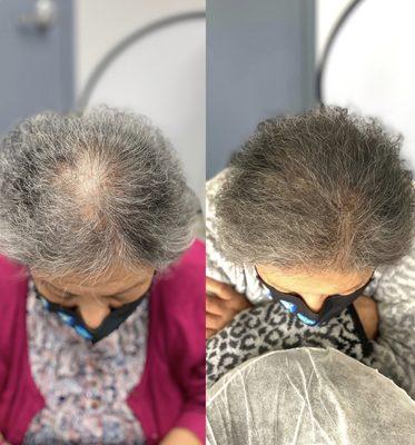 Scalp micropigmentation for women's hair loss. Before and after treatments by master artist Veronica Hernandez in Bethesda, Maryland.