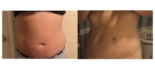 17 series with Lipo Sculpt Lite, Ultrasonic Cavitation and Thermalift (RF)