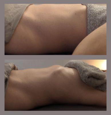 Before and After Abdominal Drainage using a unique technique of modeling and lymphatic drainage therapy.