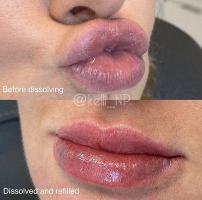 Lip Filler Correction