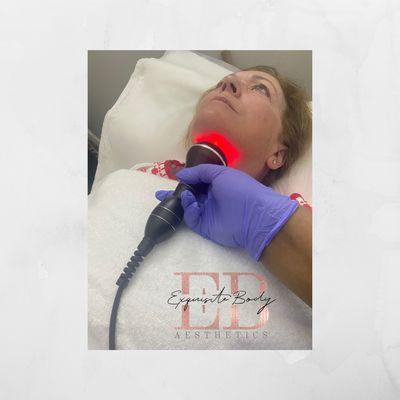 Radio frequency facial for double chin removal.