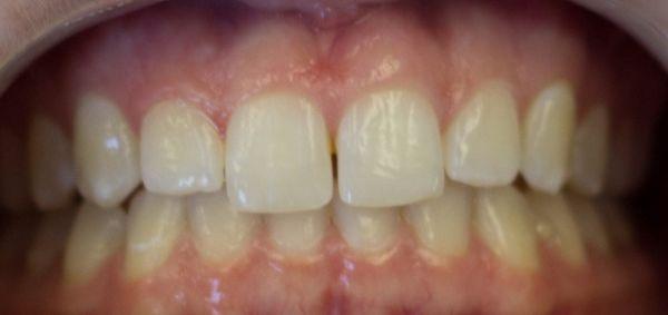 GLO Whitening before!!!