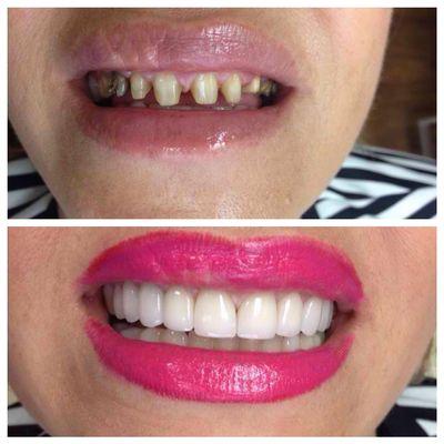 Replaced her old crowns that showed dark lines along the gum line.