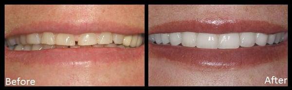 Porcelain Veneers and Crowns