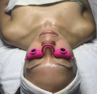 Microdermabrasion Facial