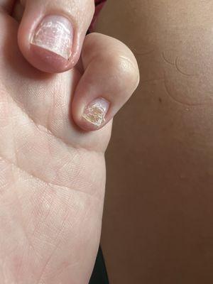 Infected nail