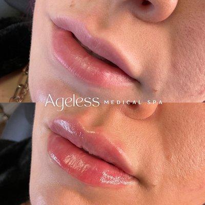 Ageless Lip Filler Results