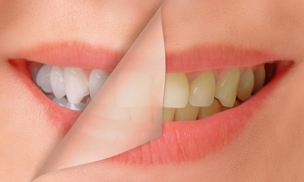 Zoom Whitening