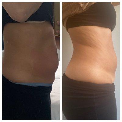 LipoDissolve & Body Contouring