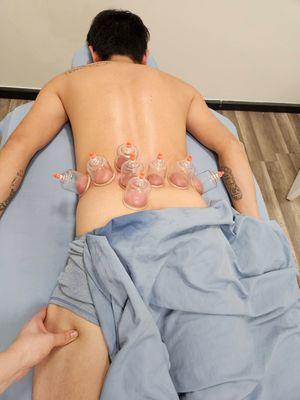 Cupping therapy