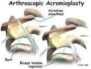 Acromioplasty