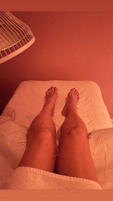 Acupuncture on my legs after intense bruising and swelling from a 100 miles race, sub 25 hours finish.