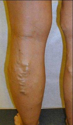 Before varicose vein treatment.