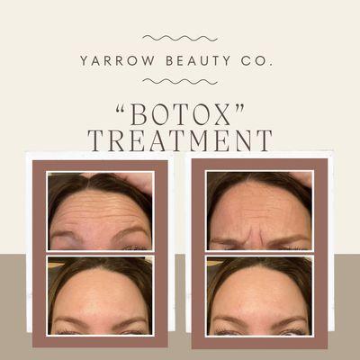 Botox treatment before and after