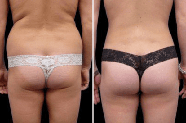 Liposuction, Brazilian Butt Lift Before & After