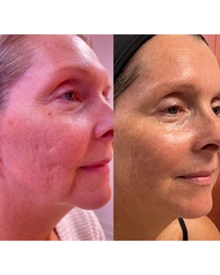 3 Advanced Plasma Treatments, 2 Age Defying Facials