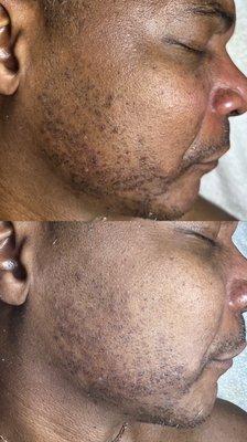 Hyperpigmentation and ingrown facial