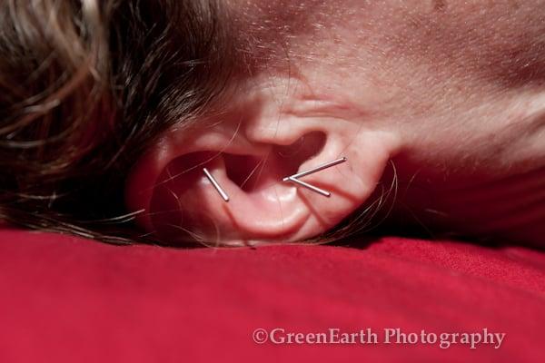 Auricular acupuncture