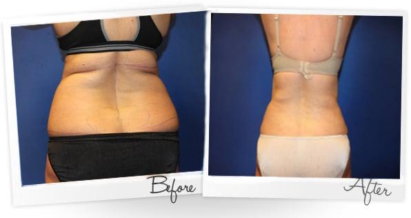 Before of After of SMARTLipo on the back