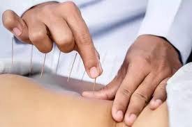 Acupuncture needles