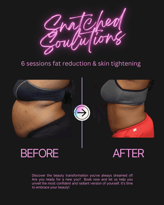 Tummy tuck