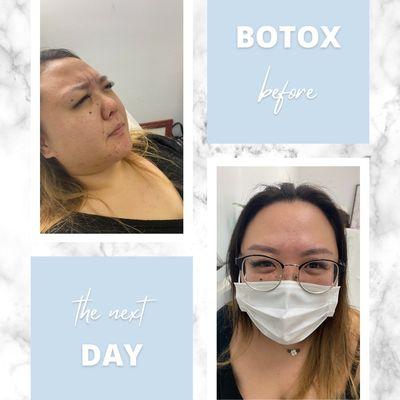 Botox before and after!