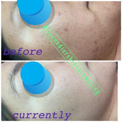 client cleared of acne within 6 months