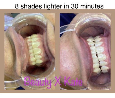 30 minute Teeth whitening