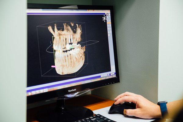 Our in-office Cone beam CT technology allows for 3-D diagnosis and treatment planning