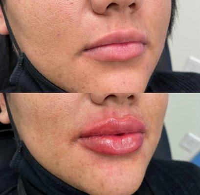 Before and after lip filler enhancement